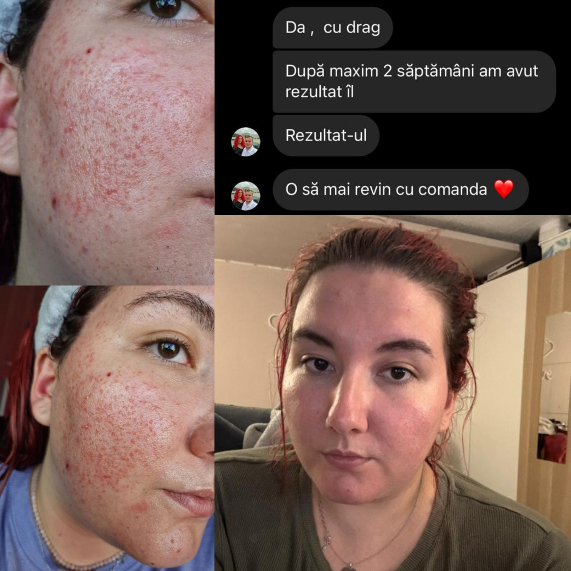 produse ingrijire ten acneic