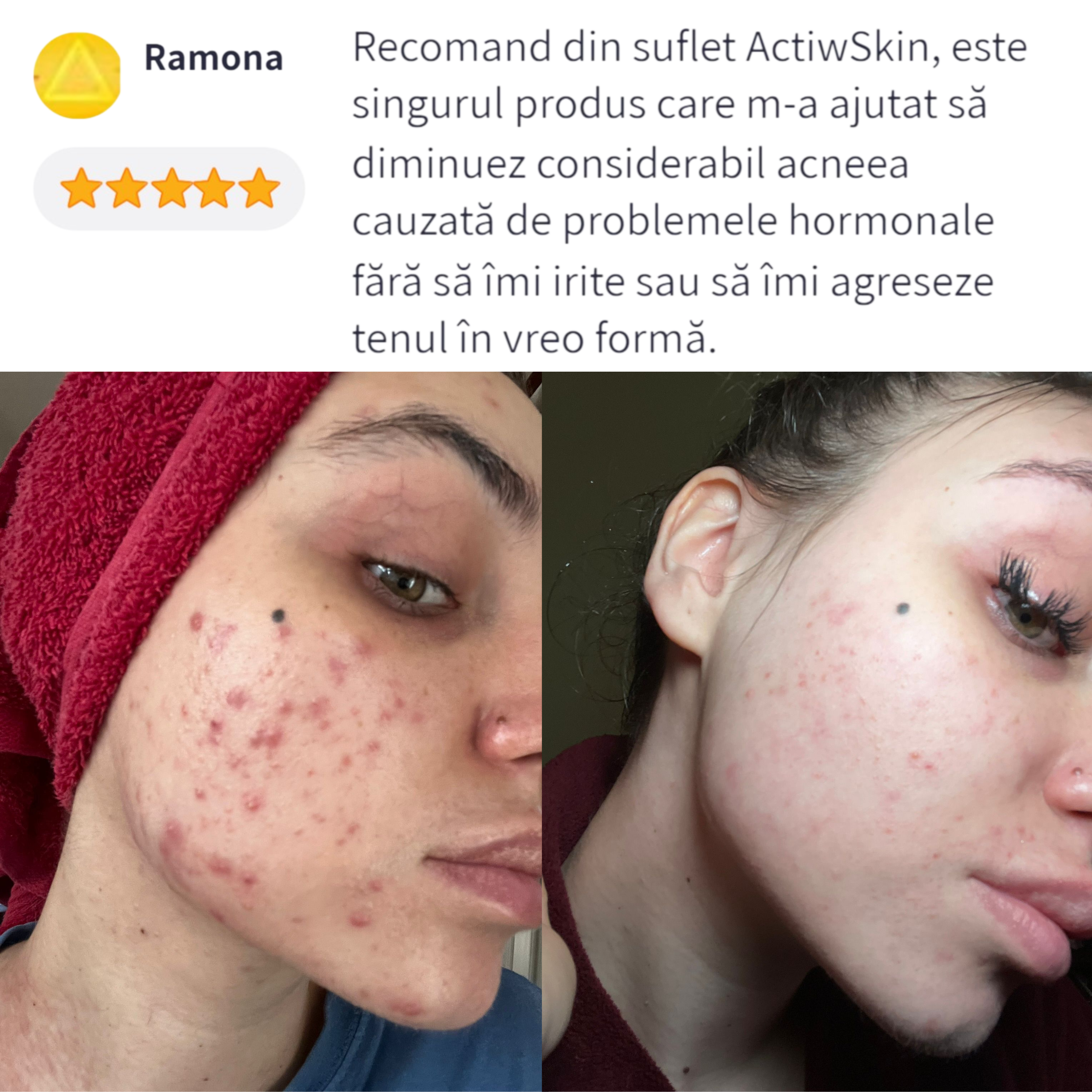 remedii pentru acnee