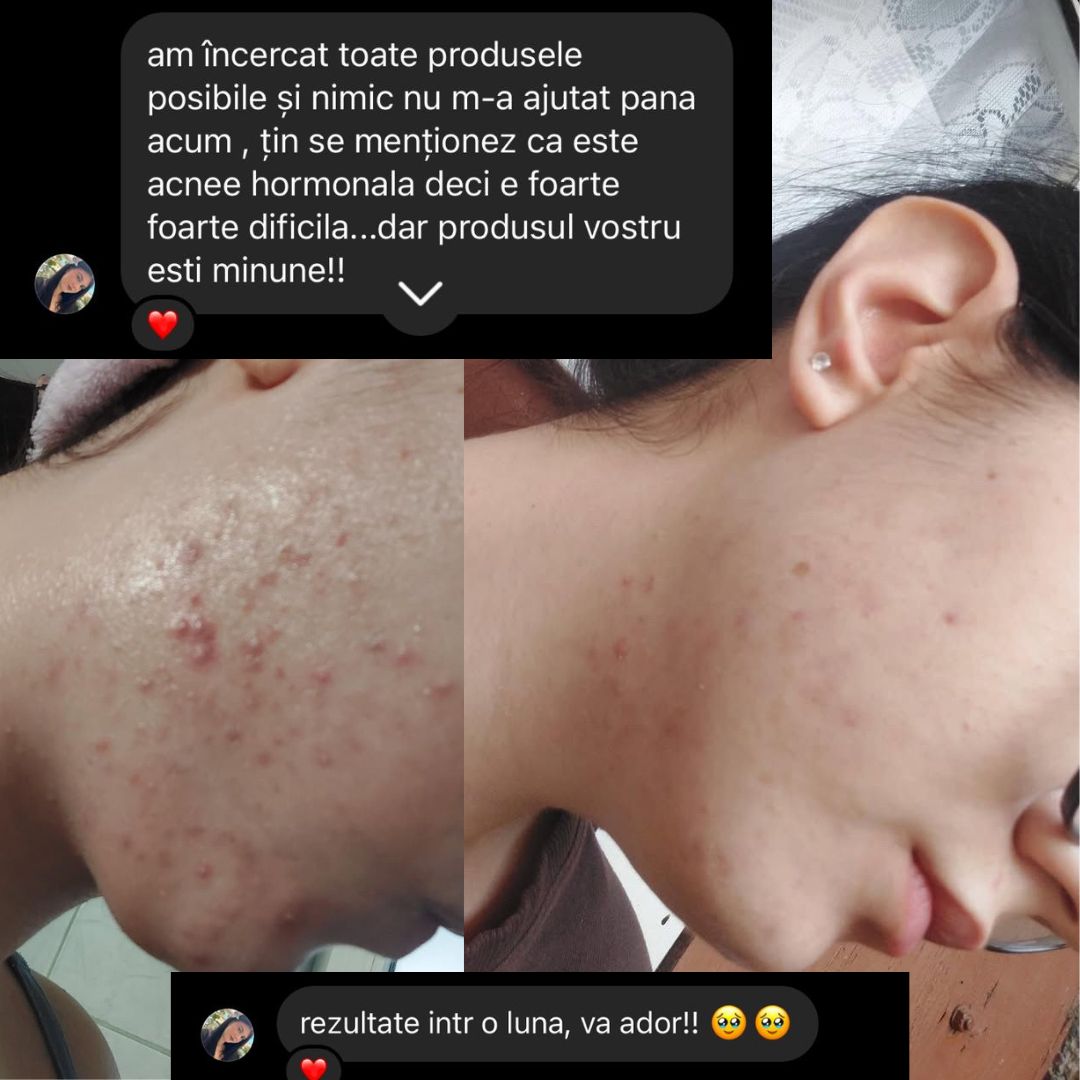 acnee remedii